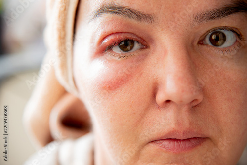 Close-Up of a Middle-Aged Woman with a Swollen Eyelid and Stye