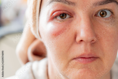 Close-Up of a Middle-Aged Woman with a Swollen Eyelid and Stye