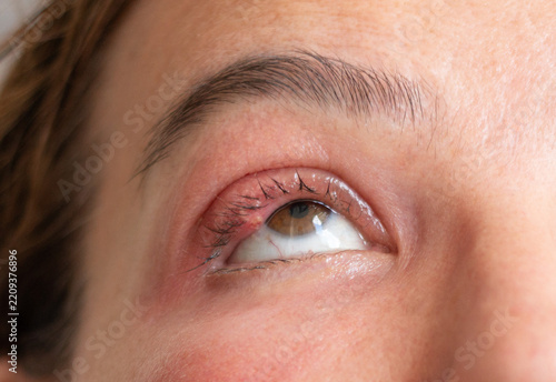 Close-Up of a Middle-Aged Woman with a Swollen Eyelid and Stye
