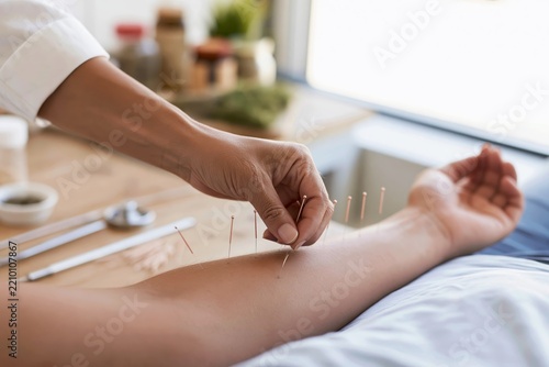 Closeup of a practitioner inserting thin metallic acupuncture needles into a patient's forearm resting on a white sheet, clinical tools and herbal containers arranged on a wooden table in soft