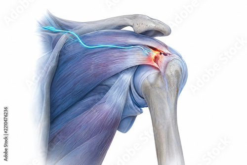 Medical of human shoulder joint pain and nerve inflammation