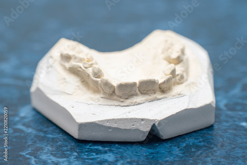 Dental plaster model of teeth and jaws for orthodontic diagnosis