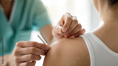 Pro therapist performs acupuncture treatment on female patient shoulder. Specialist inserts thin needles into skin for pain relief, holistic wellness. Close up macro shot of alternative medicine