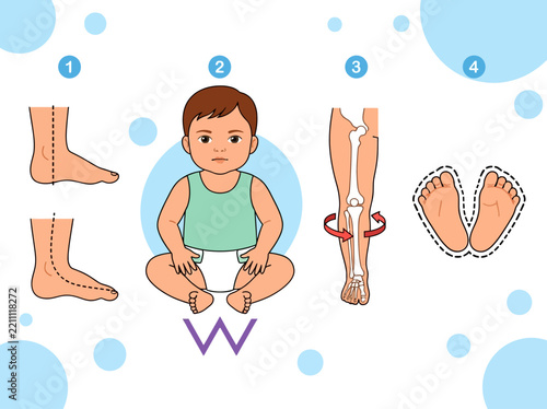 Orthopedic Diagram of Baby W-Sitting Position and Pediatric Leg Development Issues Including Flat Feet and Bone Rotation