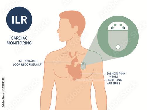 Medical Illustration of an Implantable Loop Recorder (ILR) for Cardiac Monitoring and Heart Rhythm Tracking