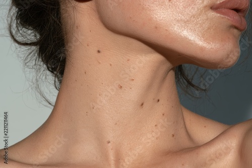 Woman's skin revealing various moles and blemishes on her neck and chest