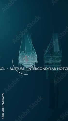 Vertical video: Animating clear left-knee on teal arc drawing causing red pulse marking ACL tear