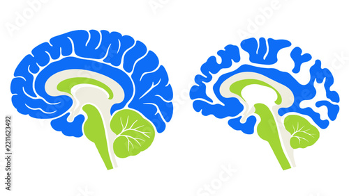 Obraz na plátně Two sagittal brain cross sections with cerebellum and brainstem