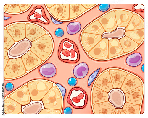 Acute glomerulonephritis tubulointerstitial, illustration