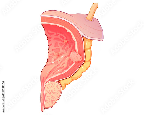 Stage T2 bladder cancer, illustration