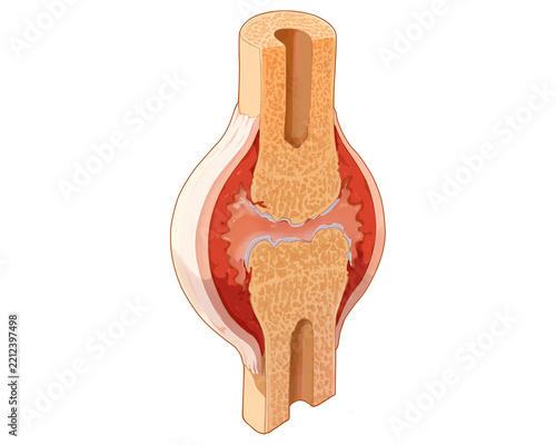 Mid-stage rheumatoid arthritis, illustration