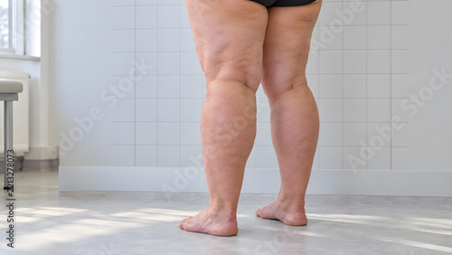 Clinician photographs lower legs for standardized lipedema follow-up documentation