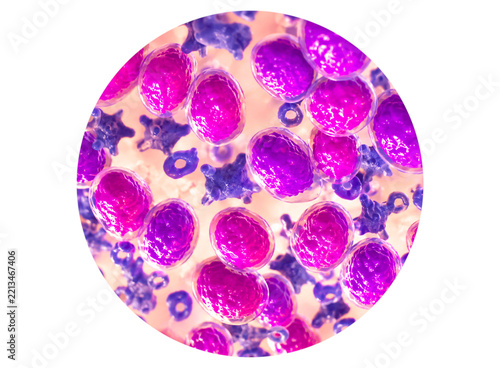Acute myeloid leukemia (AML) is a type of blood cancer. Microscopic examination of blasts or leukemia cells in blood smear of human. 3D Illustration