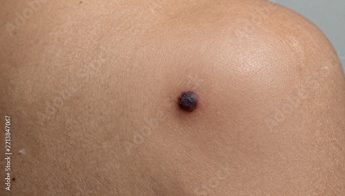 Close-up view of a dark mole on human skin with visible pores and texture