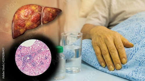 Hepatic ailment progression: liver damage, hepatitis cause, cirrhosis state, inflammation view, jaundice symptom, patient monitor, histology analysis, cell degeneration, fibrosis tissue.