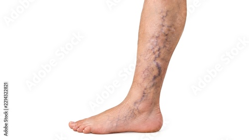Human leg with prominent varicose veins and swollen ankle showing visible twisted blood vessels isolated on white background