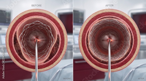 OCT-Guided Coronary Stent Expansion Assessment