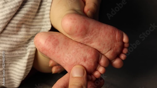 Doctor checking of baby feet affected by hand, foot and mouth disease rash or viral enterovirus infection. Close up video.