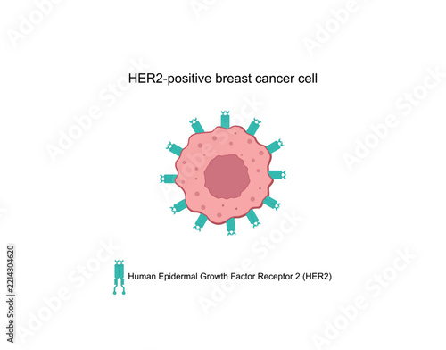 Breast cancer. HER2 protein. HER2-positive breast cancer cell. Breast cancer biomarkers including estrogen receptors, progesterone receptors, Ki-67 and HER2. Breast cancer patient awareness. 