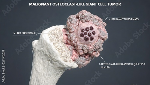 Malignant Osteoclast-like Giant Cell Tumor 3D Medical Diagram, Bone Neoplasm on Femur with Host Bone Tissue and Multinucleated Giant Cell