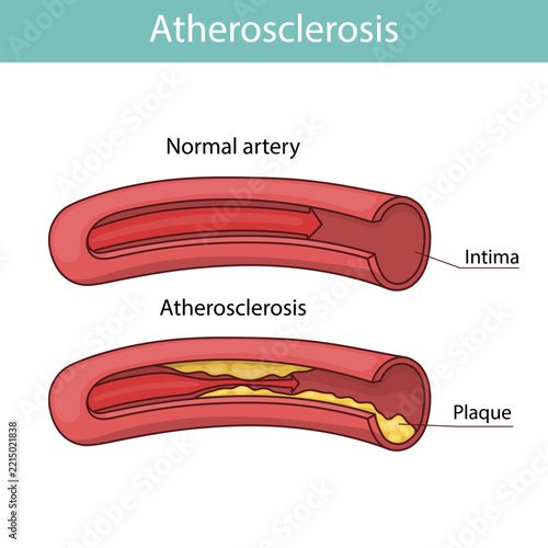 Vector illustration of healthy and atherosclerotic vessels with blood cells.