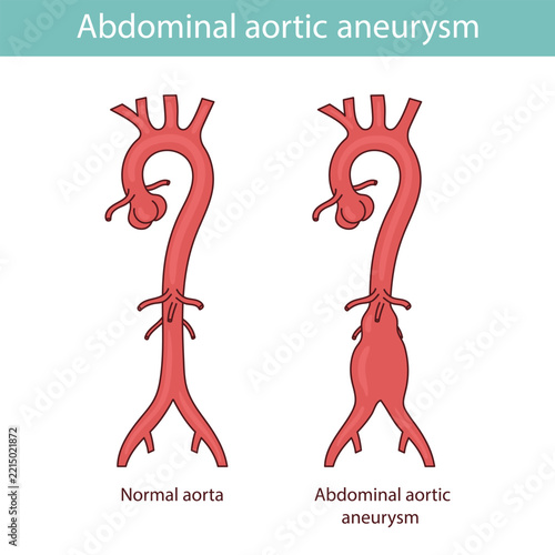 Aortic dissection. Medical vector illustration, hand drawn in cartoon style.