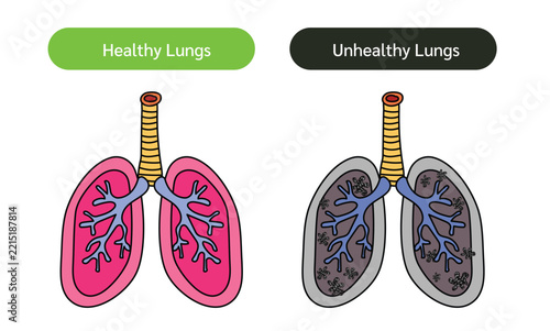 Healthy and Unhealthy Lungs Comparison Medical, vector Illustration