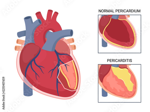 Fotografie Pericarditis vs Normal Heart Anatomy Medical Illustration showing Pericardium In