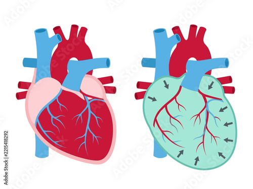 Obraz na plátně Comparison Diagram of a Healthy Human Heart vs Cardiac Tamponade and Pericardial