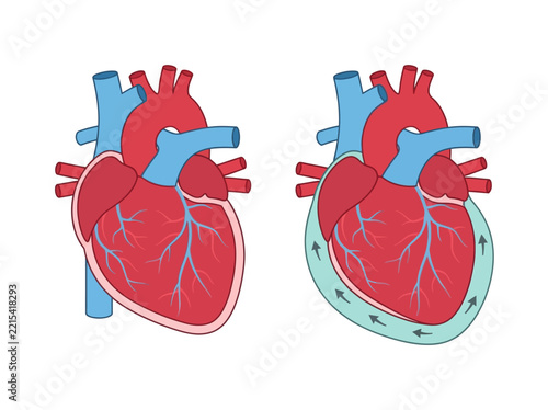 Obraz na plátně Pericardial Effusion and Cardiac Tamponade vs Normal Heart Anatomy Comparison Di