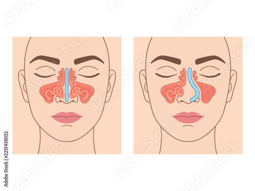 Deviated Nasal Septum vs Normal Septum Comparison - Medical Illustration of Human Nasal Anatomy, Sinus Cavity, and Breathing Obstruction