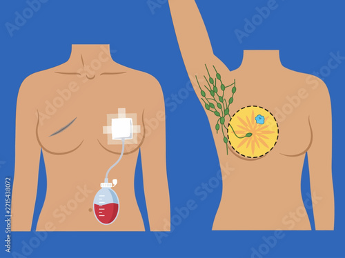 Breast Cancer Surgery Illustration showing Mastectomy, Lumpectomy, Post-operative Surgical Drain, and Axillary Lymph Node Anatomy for Medical Education