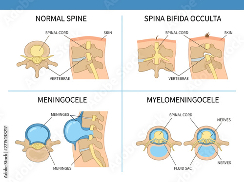 Medical Diagram of Spina Bifida Types: Normal Spine, Occulta, Meningocele, and Myelomeningocele. Comparison of Neural Tube Defects and Spinal Cord Malformations.