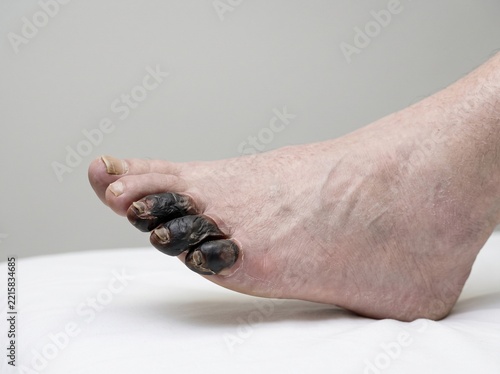 Peripheral Arterial Disease with Dry Gangrene and Ischemic Necrosis of Toes