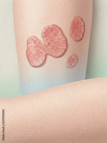 Medical illustration depicts raised erythematous psoriasis plaques on human skin