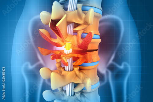 Human spinal cord injury, broken spine, back pain on blurred background. 3d illustration
