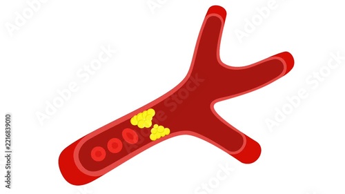 Blood vessel blocked by cholesterol fat plaque animation, artery clogging concept with red blood cells.