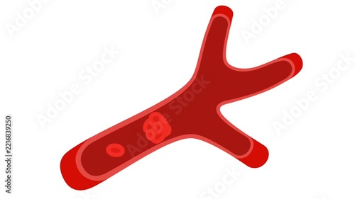 Animation of a blood clot inside a blood vessel.