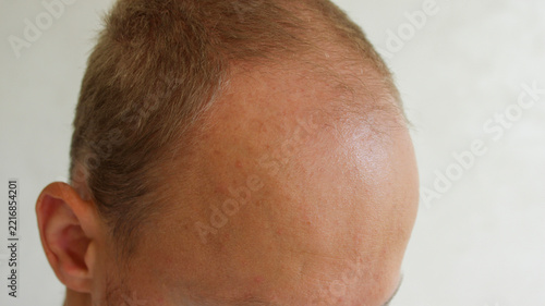 Fotografie Close up view of man scalp showing receding hairline and male pattern baldness