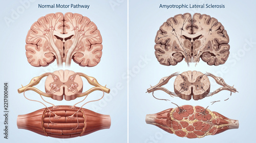 Normal Motor Pathway vs ALS Anatomy 3D Render