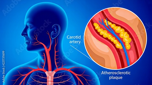 Atherosclerosis in carotid artery showing plaque buildup and restricted blood flow in human neck anatomy