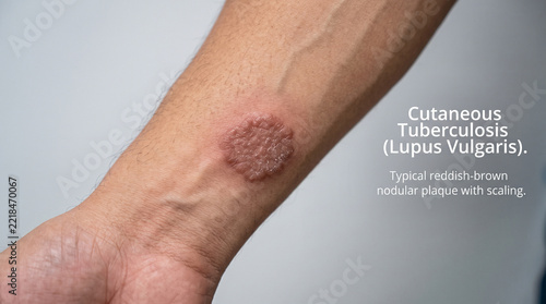 Detailed medical illustration showing cutaneous tuberculosis lupus vulgaris skin lesion on human arm