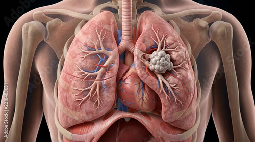 3D Anatomical Illustration of Human Lungs with Cancerous Tumor
