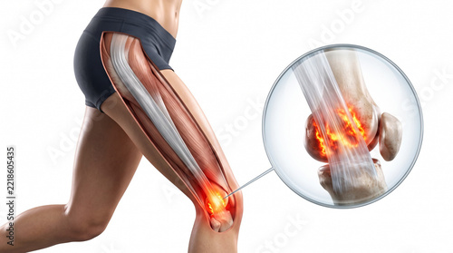 IT band syndrome 3D anatomy illustration. Runner leg with skin cutaway showing outer thigh band and glowing friction at knee in zoomed close up on white