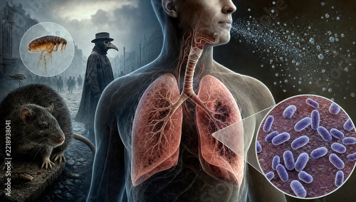 Pneumonic plague infection.