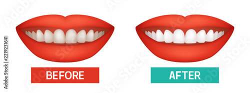 Teeth whitening. Before and after. Hand-drawn 3D vector clip art.
