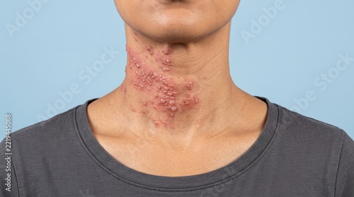 Shingles virus or severe blistering skin rash on the neck of a person