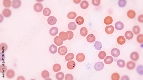 Microscopic view of Plasmodium vivax malaria parasites in human blood smear slides