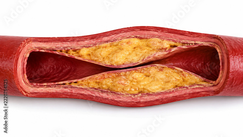 cross-section of human artery with atherosclerotic plaque buildup and layered fatty deposits on white background