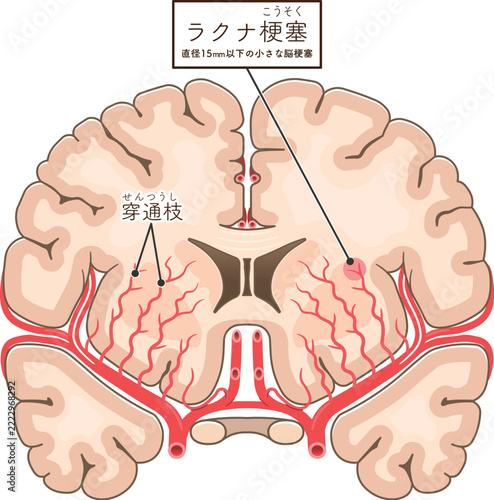 ラクナ梗塞　Lacunar infarction